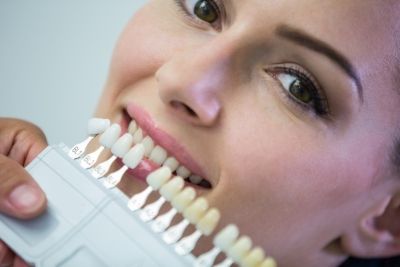 Carillas dentales: qué son, tipos y cuidados