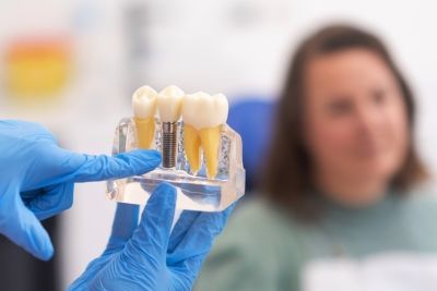 Implantes dentales: proceso, ventajas y cuidados