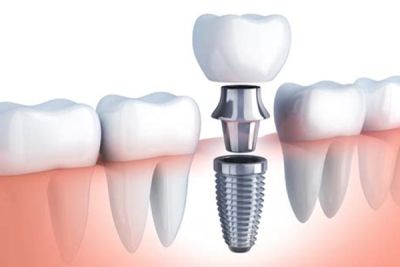 Dental implants