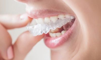Invisible orthodontics with Spark: how it works step by step