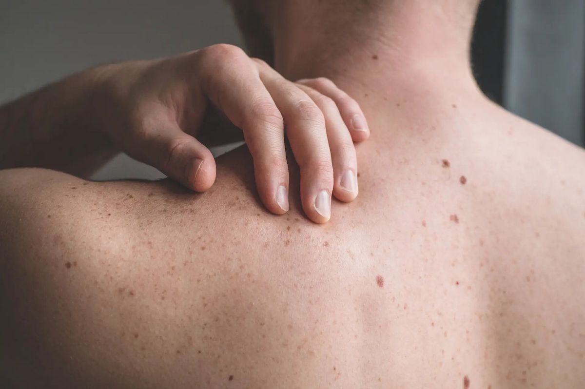 Lunares peligrosos: la regla ABCDE y cuándo acudir al dermatólogo