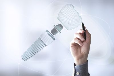 ¿Qué es un implante dental y cuándo se coloca?