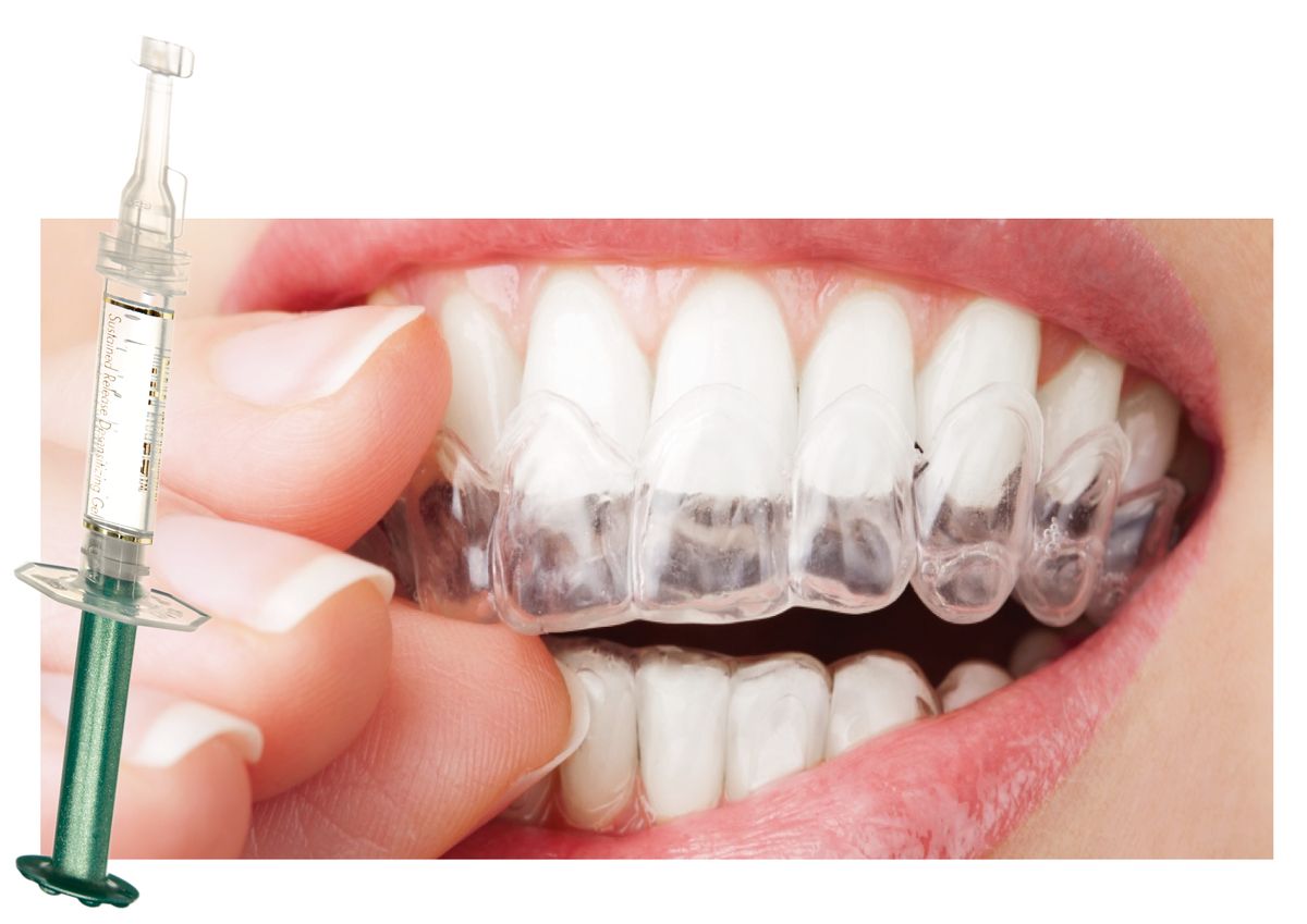 Blanqueamiento dental domiciliario mediante férula
