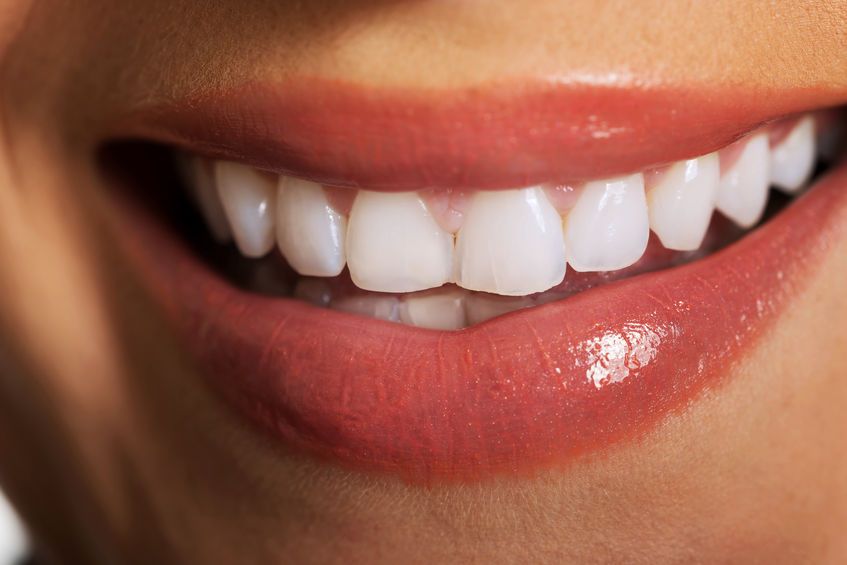 Carillas dentales