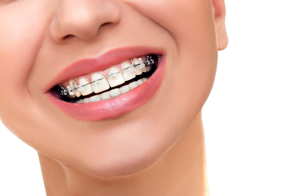 Brackets estéticos en Ortodoncia