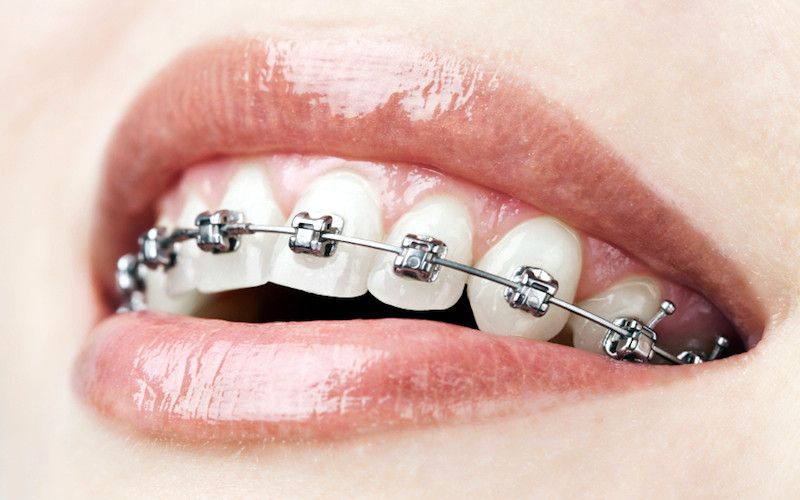 Ortodoncia con brackets: la opción de referencia