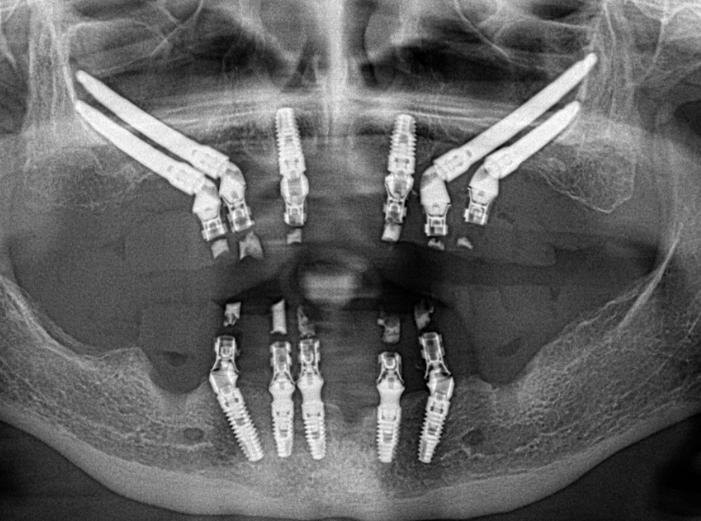 Radiografía panorámica con implantes zigomáticos a ambos lados del maxilar superior e implantes convencionales